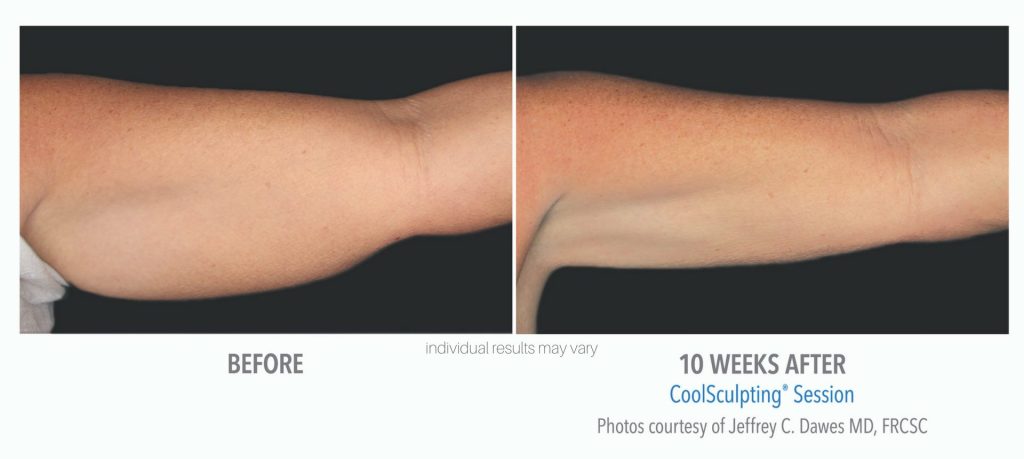 Sculptology-CoolSculpting-before-and-after-6