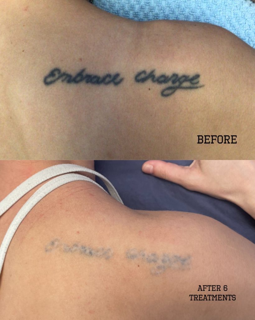 Laser Tattoo Removal | tattoo removal methods - NYC by Dr Ron Shelton