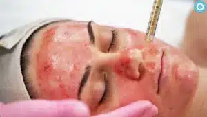 Vampire Facial