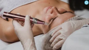 stem cell microneedling